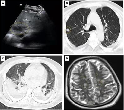 Phenotypic and Molecular Characterization of K54-ST29 Hypervirulent Klebsiella pneumoniae Causing Multi-System Infection in a Patient With Diabetes